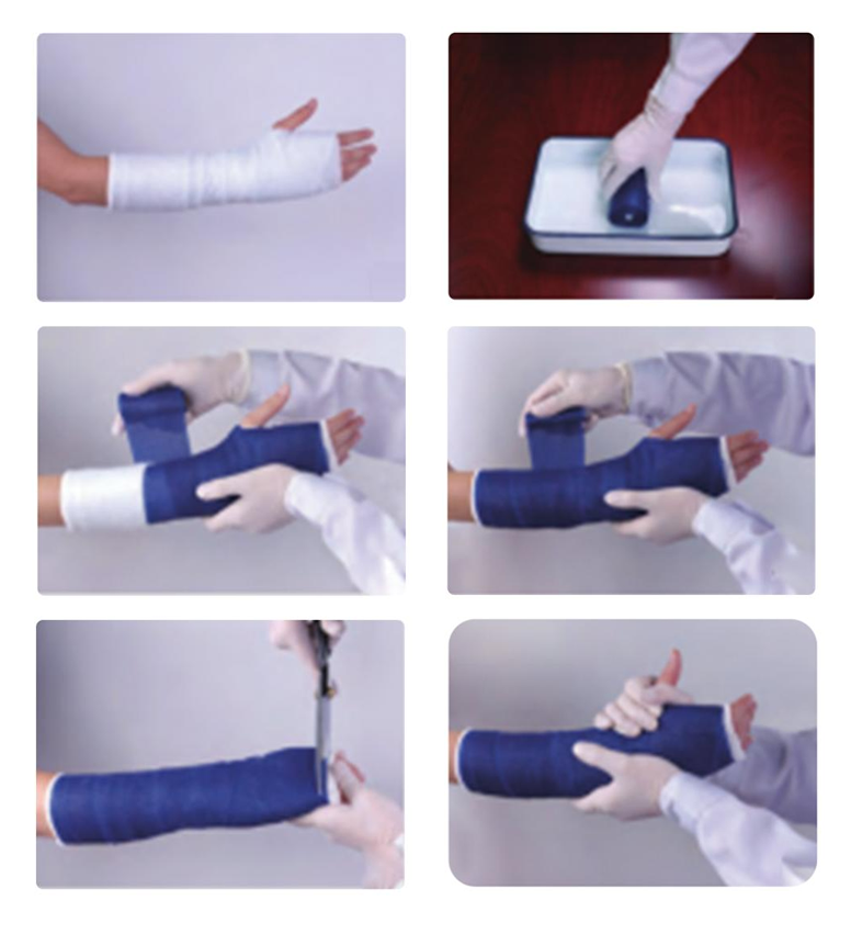 ขั้นตอนการใช้ Orthopedic Casting Tape